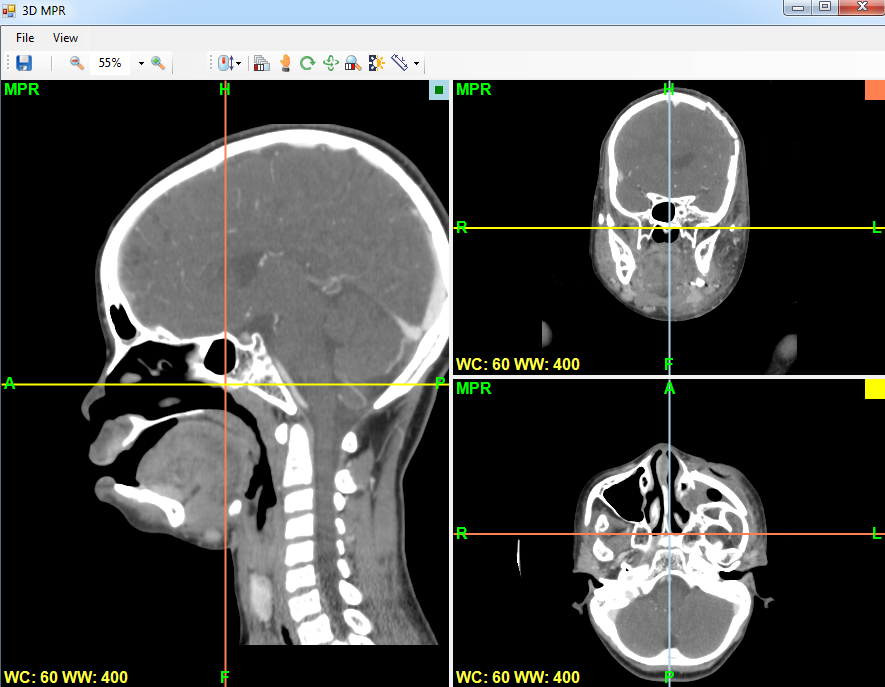 Screenshot of 3 image viewers, which display coronal, sagittal and axial DICOM MPR planar slices